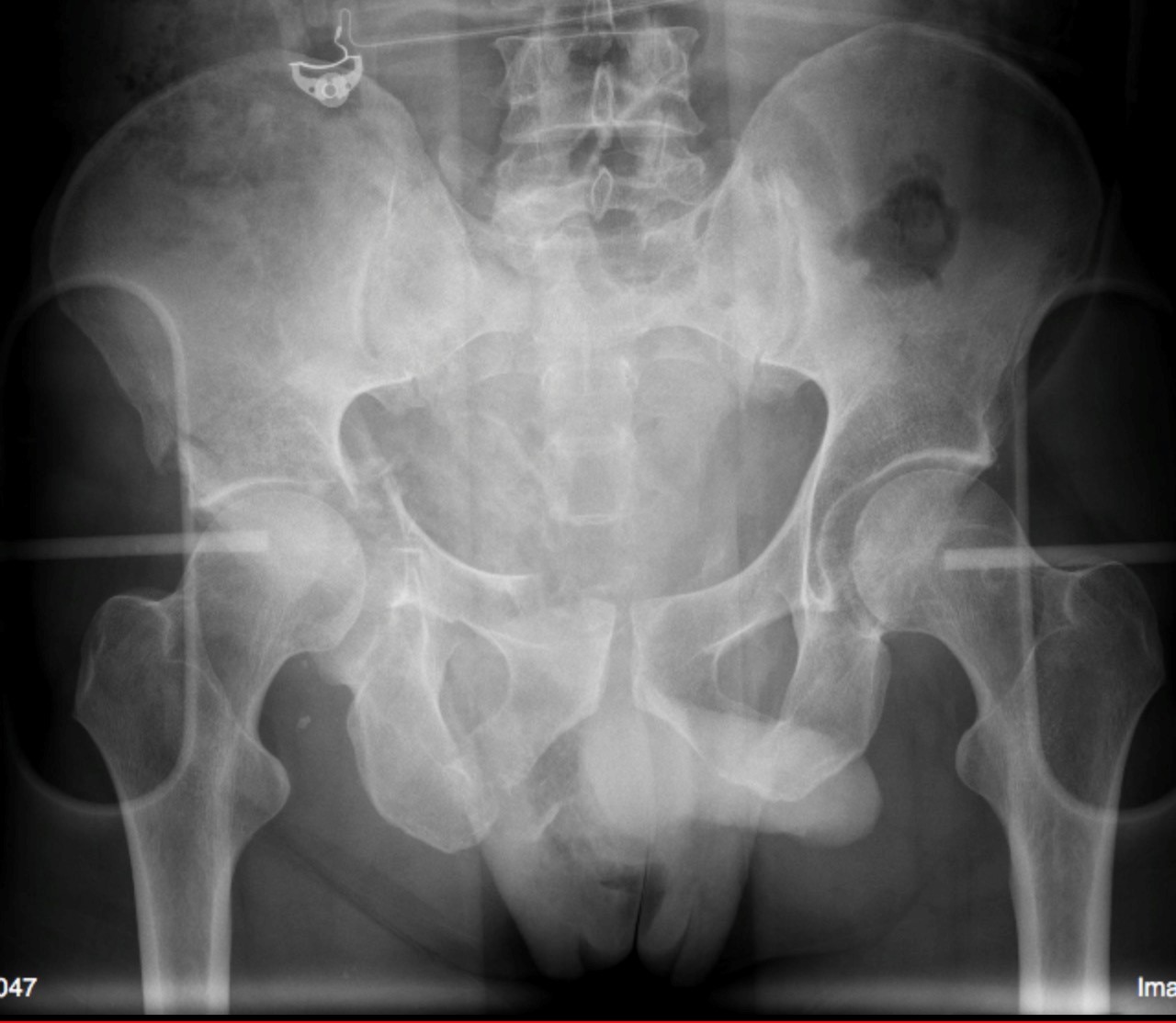 How Is A Broken Pelvic Bone Treated