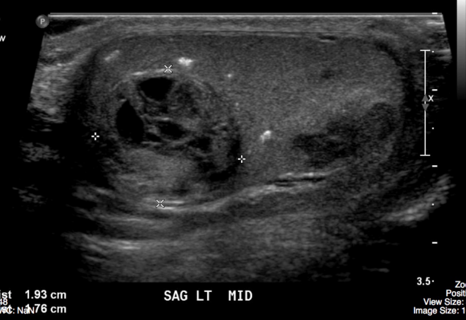 testicular-tumour-undergraduate-diagnostic-imaging-fundamentals