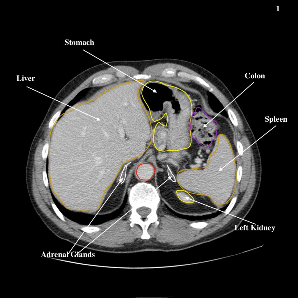 Abdomen – Undergraduate Diagnostic Imaging Fundamentals