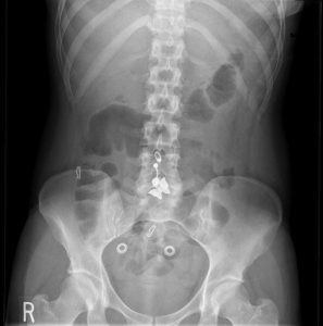 Approach to the Abdominal X-ray (AXR) – Undergraduate Diagnostic ...