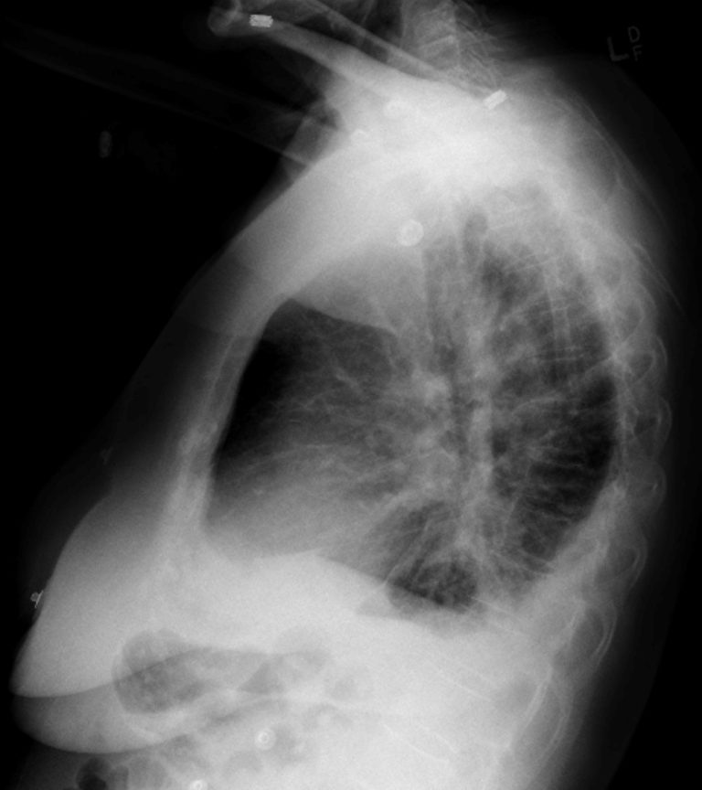 Congestive Heart Failure – Undergraduate Diagnostic Imaging Fundamentals