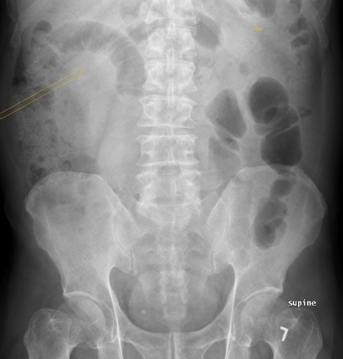 ileus-undergraduate-diagnostic-imaging-fundamentals