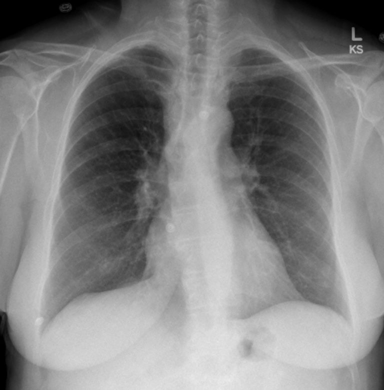 Pulmonary Thromboembolism – Undergraduate Diagnostic Imaging Fundamentals