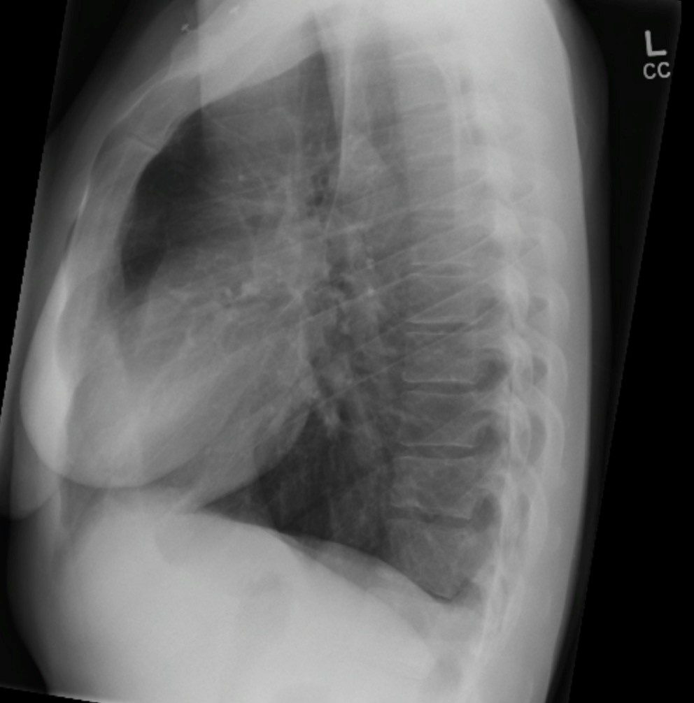 Pneumothorax Undergraduate Diagnostic Imaging Fundamentals