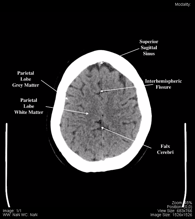 normal brain ct anatomy