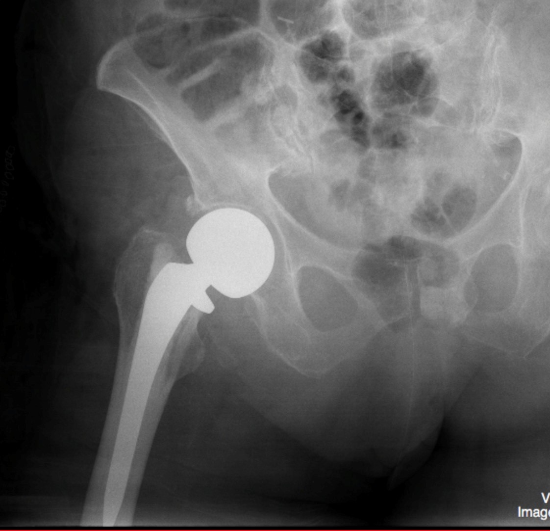 broken hip x ray