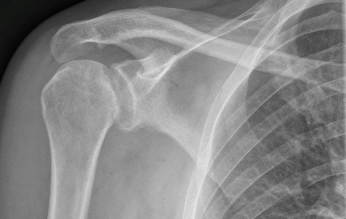 Glenohumeral Dislocation Anterior and Posterior Undergraduate