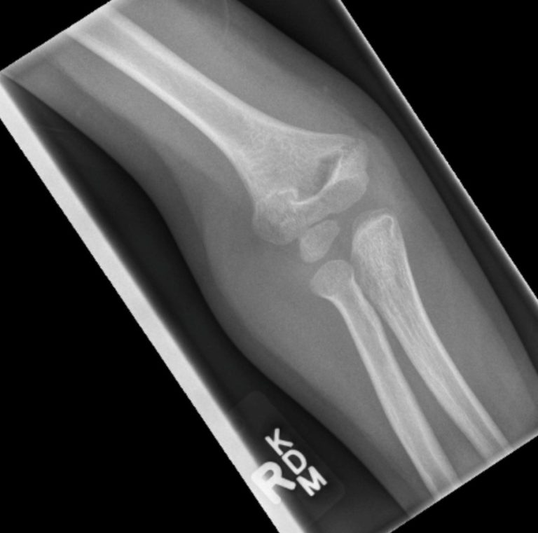 Elbow Fractures Undergraduate Diagnostic Imaging Fundamentals 8311