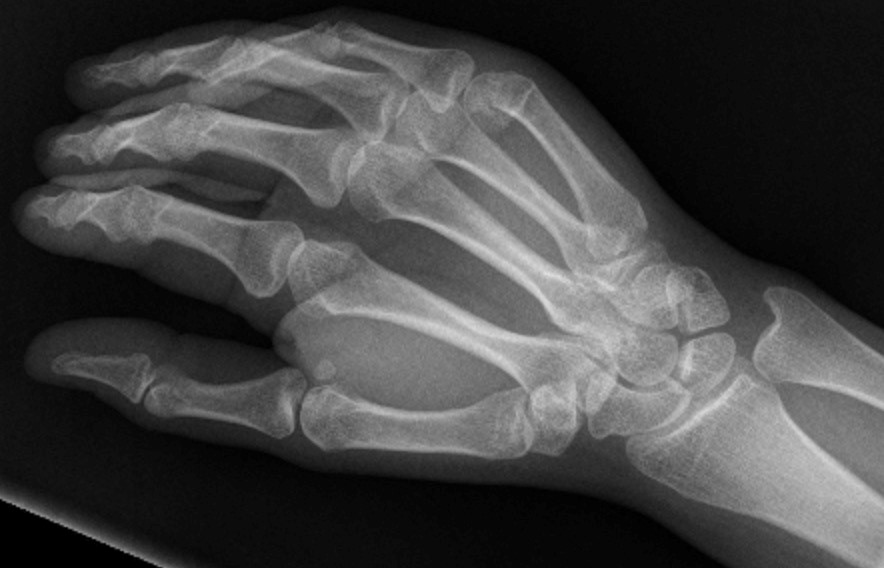 Hand And Wrist Fractures Undergraduate Diagnostic Imaging Fundamentals