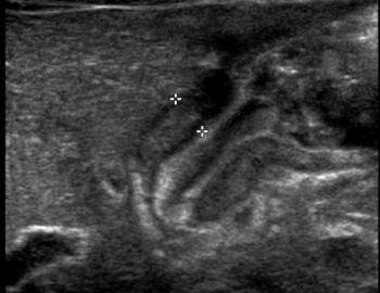 Pyloric Stenosis – Undergraduate Diagnostic Imaging Fundamentals