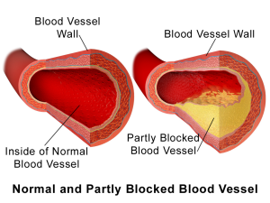 Normal vs Partly Blocked Blood Vessel