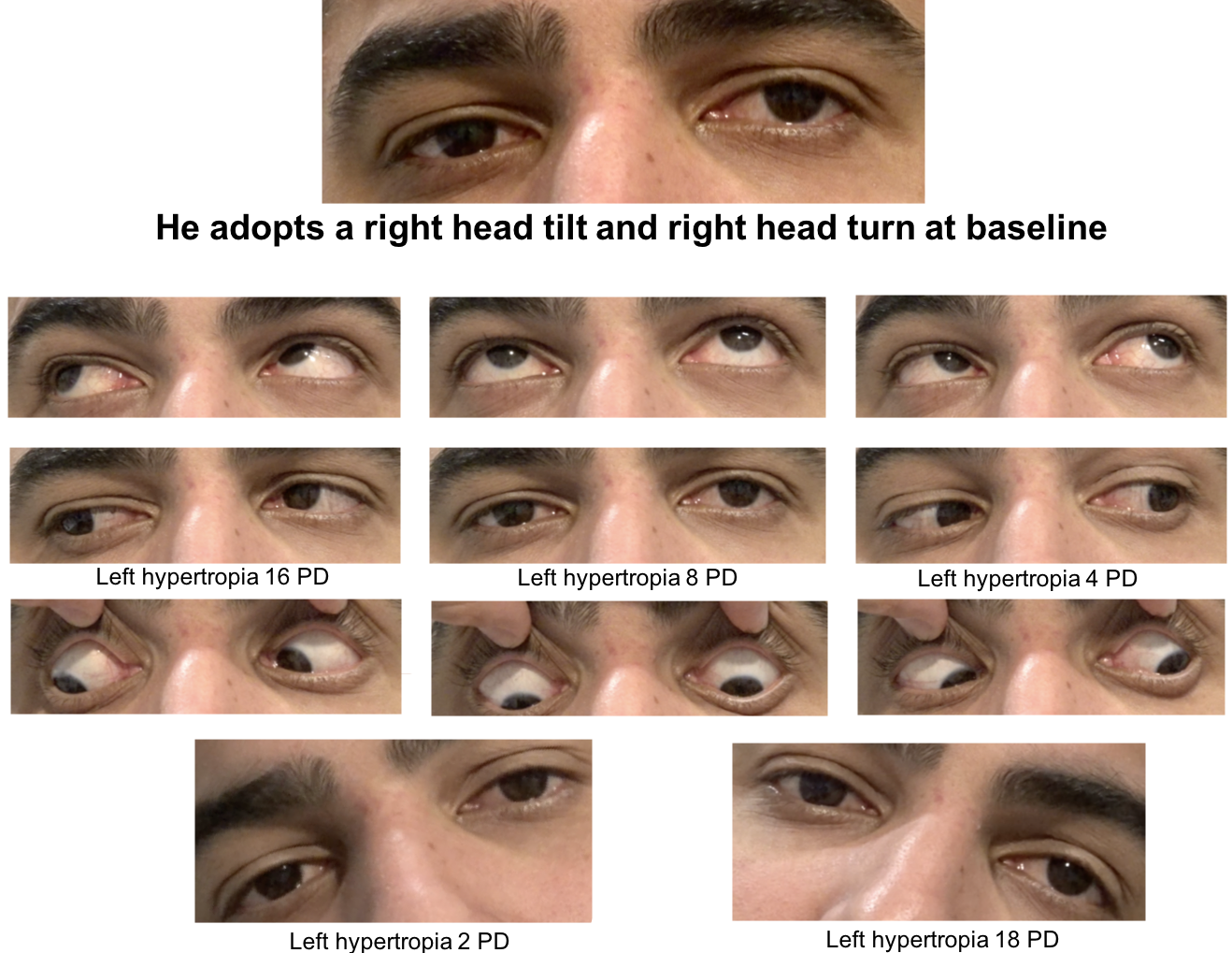 Trochlear Nerve Palsy Eye Position