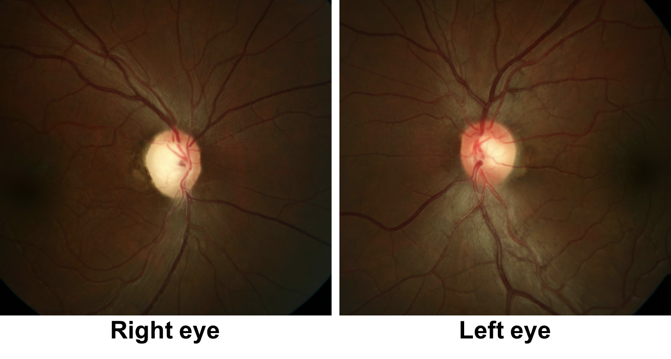 An 18-year-old man with dominant optic atrophy (DOA). The fundus