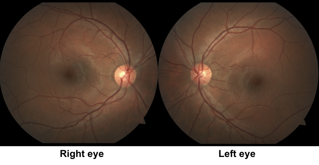 Nonorganic vision loss – Case-Based Neuro-Ophthalmology