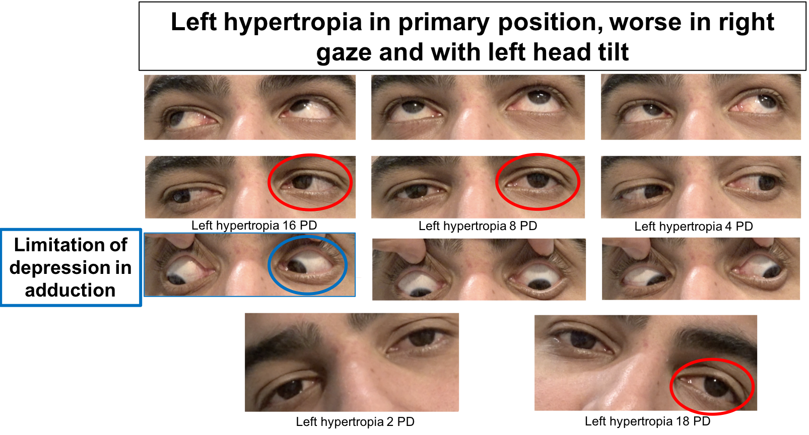 Fourth nerve palsy – Case-Based Neuro-Ophthalmology