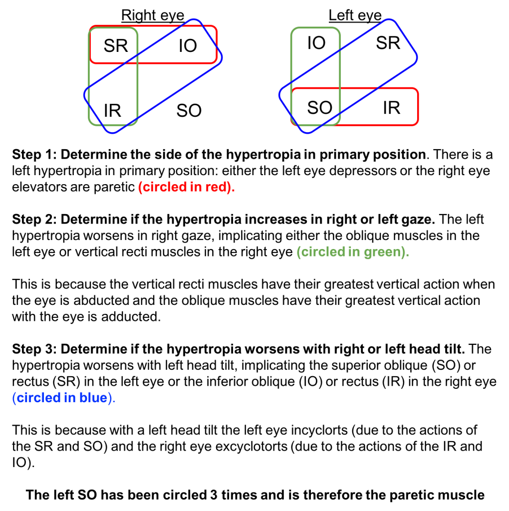 Fourth nerve palsy CaseBased NeuroOphthalmology
