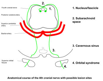 Fourth nerve palsy – Case-Based Neuro-Ophthalmology