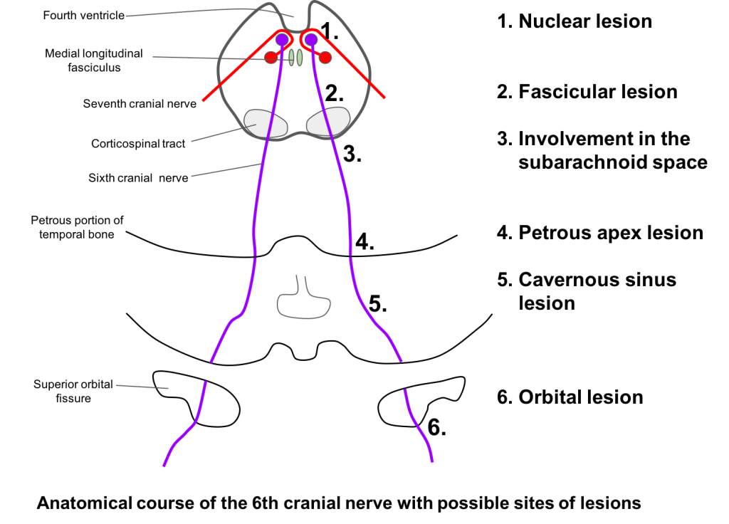 Sixth Nerve Palsy Case Based Neuro Ophthalmology 7971