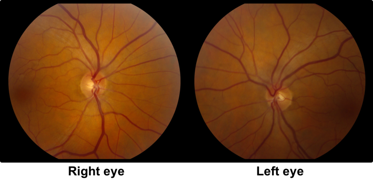 Internuclear ophthalmoplegia – Case-Based Neuro-Ophthalmology