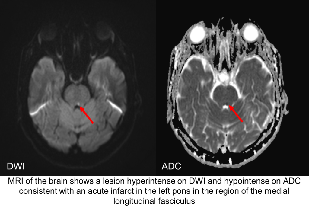 Internuclear ophthalmoplegia – Case-Based Neuro-Ophthalmology