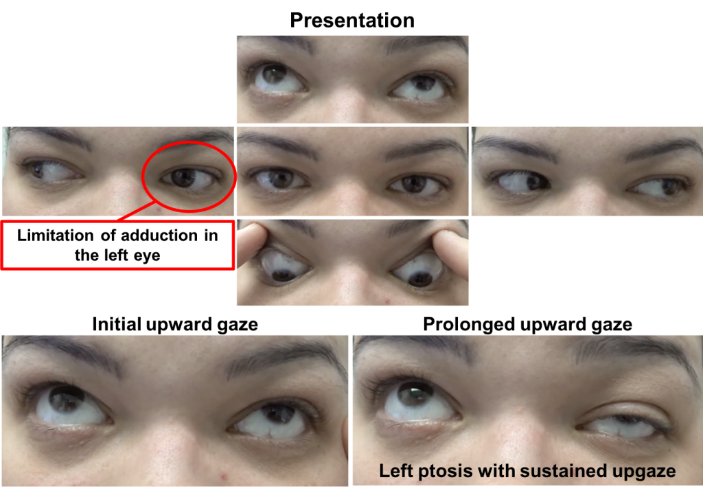 Ocular myasthenia gravis CaseBased NeuroOphthalmology
