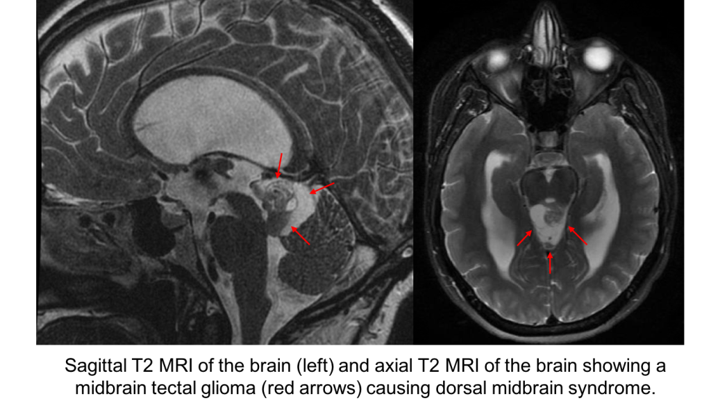 Dorsal Midbrain Syndrome Case Based Neuro Ophthalmology