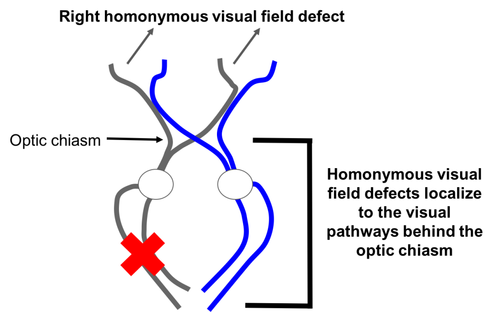Superior homonymous quadrantanopia CaseBased NeuroOphthalmology