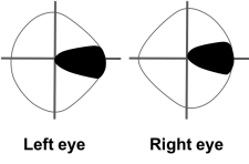 superior quadrantanopia icd 10