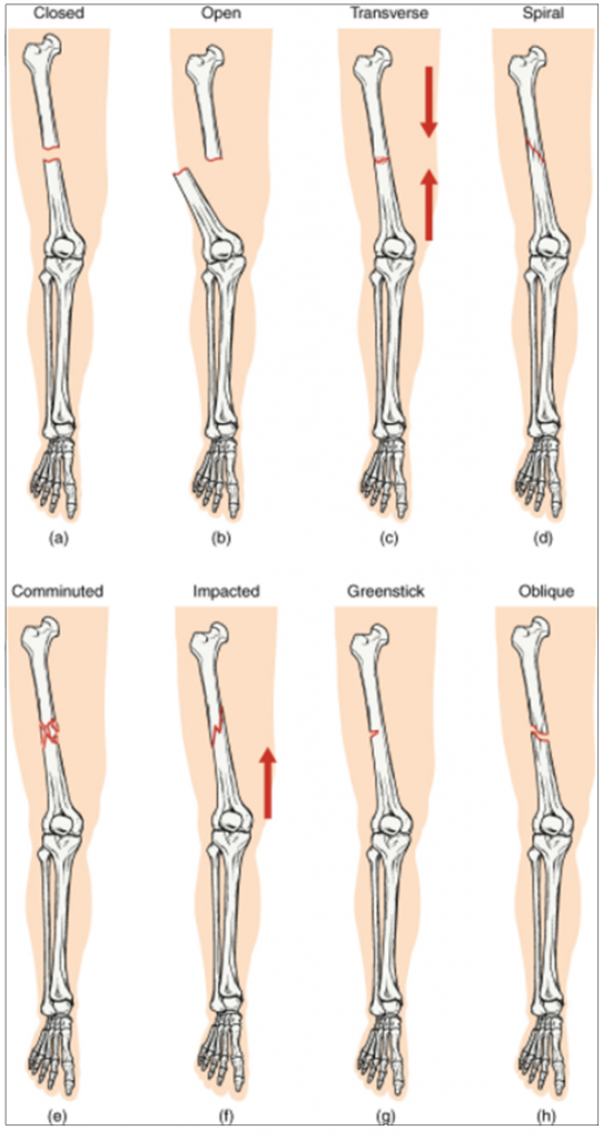 Types of fractures. Compare healthy bone with different types of fractures: (a) closed fracture, (b) open fracture, (c) transverse fracture, (d) spiral fracture, (e) comminuted fracture, (f) impacted fracture, (g) greenstick fracture, and (h) oblique fracture.