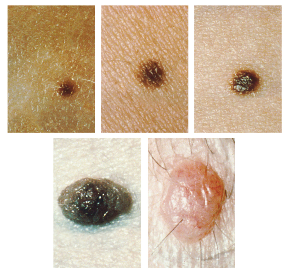Photos of different types of moles