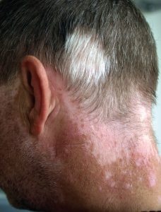 Photo of back of man's neck, showing vitligo, where there is different coloured patches of skin