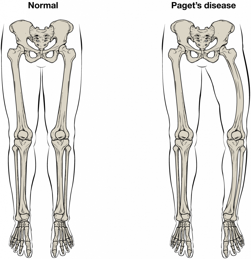 Normal bone vs paget disease bones