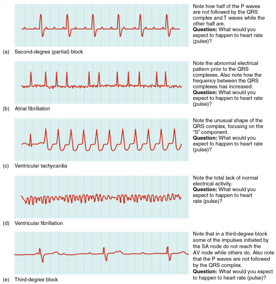 Figure 6.2.9. Common ECG abnormalities. (a) In a second-degree or partial block, one-half of the P waves are not followed by the QRS complex and T waves while the other half are. (b) In atrial fibrillation, the electrical pattern is abnormal prior to the QRS complex, and the frequency between the QRS complexes has increased. (c) In ventricular tachycardia, the shape of the QRS complex is abnormal. (d) In ventricular fibrillation, there is no normal electrical activity. (e) In a third-degree block, there is no correlation between atrial activity (the P wave) and ventricular activity (the QRS complex).