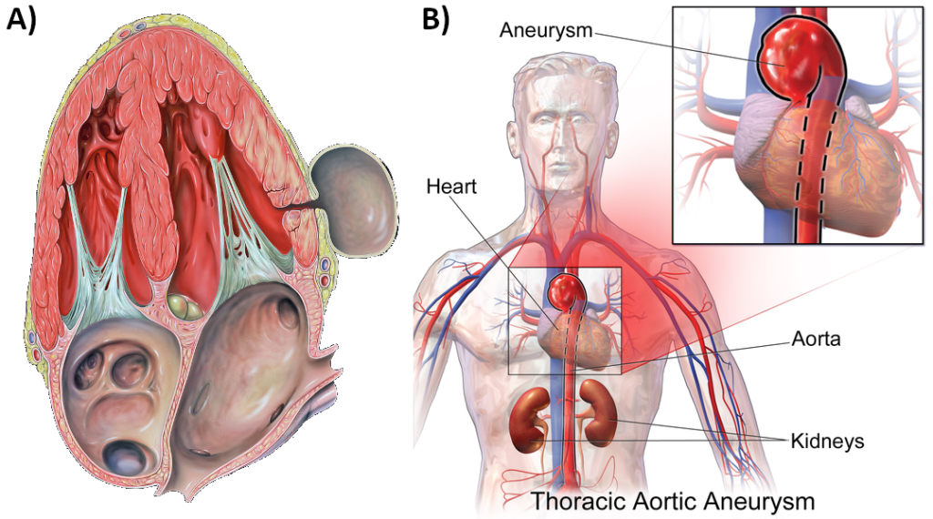A) Pseudoaneurysm of the left ventricle, four-chamber echocardiography view B) Thoracic aortic aneurysm