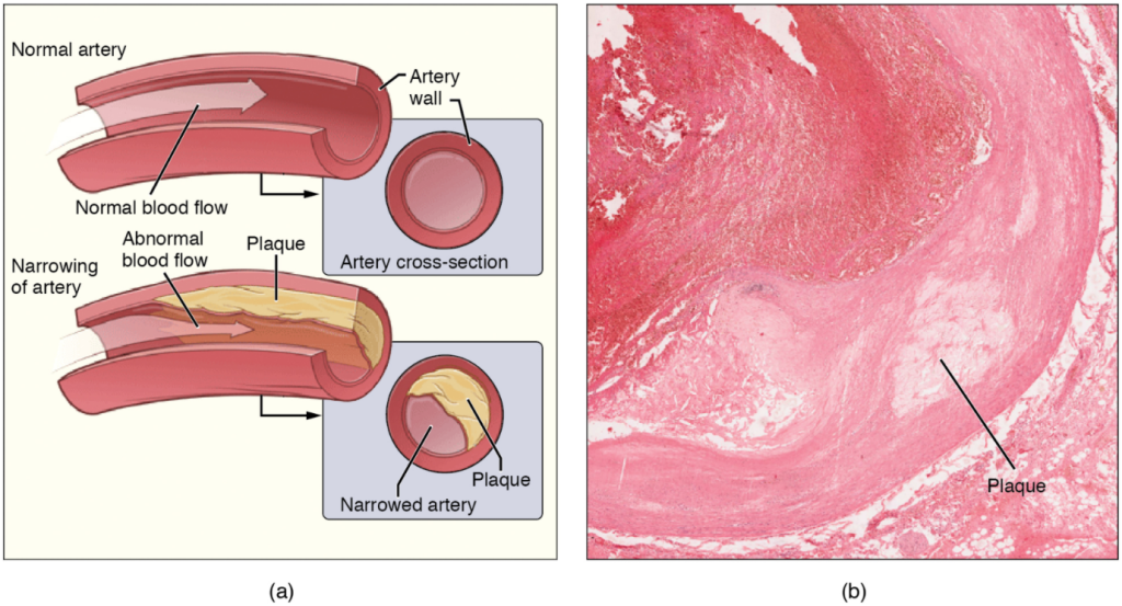 Diagram and image of Atherosclerosis