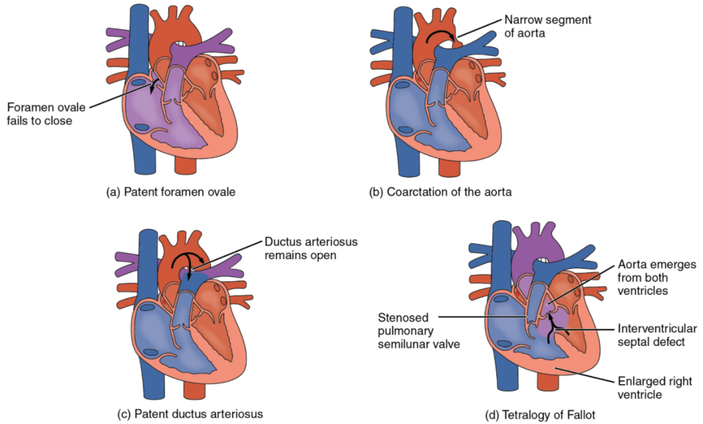 Diagram Congenital heart defects