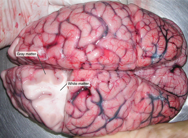 A brain removed during an autopsy, with a partial section removed, shows white matter surrounded by grey matter