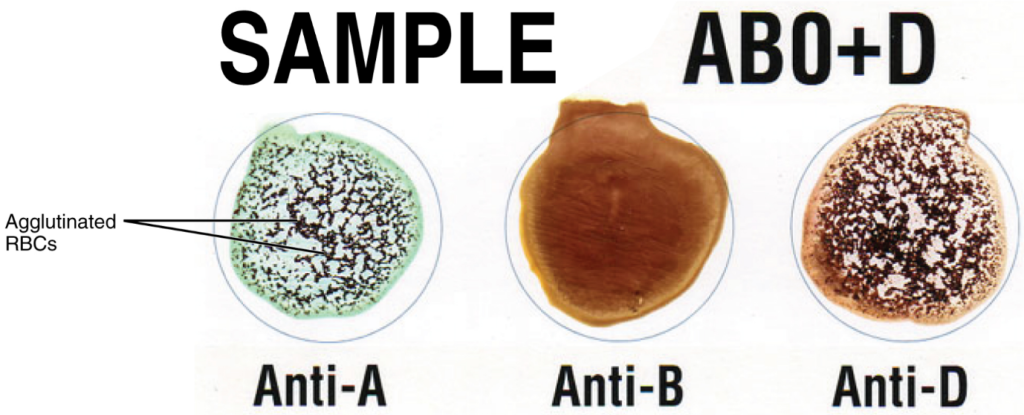 This sample of a commercially produced “bedside” card enables quick typing of both a recipient’s and donor’s blood before transfusion. The card contains three reaction sites or wells. One is coated with an anti-A antibody, one with an anti-B antibody, and one with an anti-D antibody. Mixing a drop of blood and saline into each well enables the blood to interact with a preparation of type-specific antibodies, also called anti-sera. Agglutination of RBCs in a given site indicates a positive identification of the blood antigens, in this case A and Rh(D) antigens for blood type A+. For the purpose of transfusion, the donor’s and recipient’s blood types must be compatible: the donor’s RBC must not express antigens that will react with antibodies in the patient’s plasma.