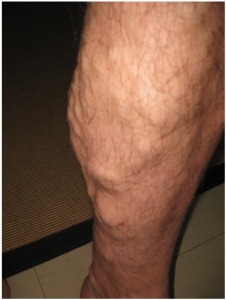 Photo of varicose veins on legs