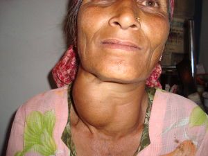 Photo showing a woman with a large growth on her neck, a goiter.