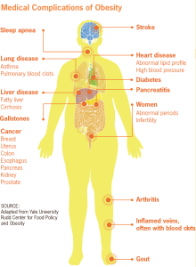 Medical Complications of Obesity include increased risks of sleep apnea, lung diseases like asthma or pulmonary blood clots, liver diseases like fatty liver or cirrhosis, gallstones, several forms of cancer, heart disease, diabetes, pancreatitis, arthritis, inflamed veins (often with blood clots), gout, and, in women, abnormal periods and infertility