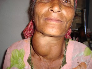 Woman with enlarged goiter in the neck.