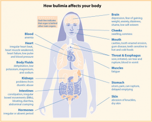 Bulimia can cause issues like anemia, lowered circulating hormones. bloating, diarrhea, constipation, irregular heart beats, brain fog, sores and irritation of the mouth, throat, and esophagus, fatigue, stomach ulcers, bruising