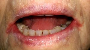 Photo of person with red cracks at the corners of the mouth, a condition called cheilosis