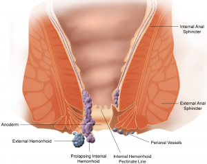 Diagram of internal and external hemorrhoids which are sores around the anus.