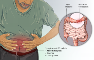 Symptoms of Irritable Bowel Syndrome (IBS) include abdominal pain, diarrhea, or constipation. The person suffers from abnormal contractions of the large intestine which causes the symptoms.