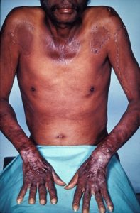 Photo of a man with severe dermatitis from pellagra.