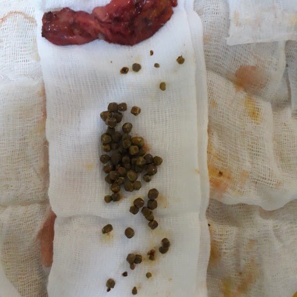 Image of 65 gallstones removed from a diseased gallbladder