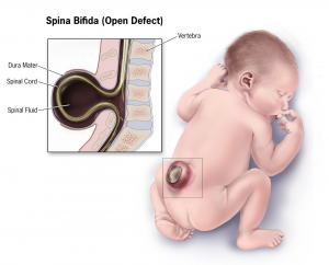 Neural tube defect called spina bifida which occurs when the spinal cord grows between the vertebrae on the outside of the body