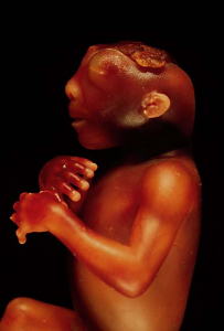 Photo of a newborn with anencephaly - a mishaped head and poorly formed brain.